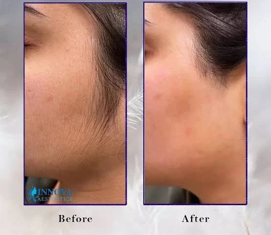 WIKI Hair Blocker Cream - Permanent Hair Removal